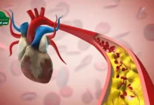 مرض الشريان التاجي