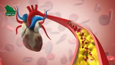 مرض الشريان التاجي