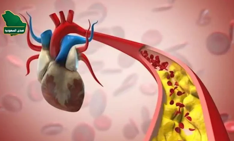 مرض الشريان التاجي